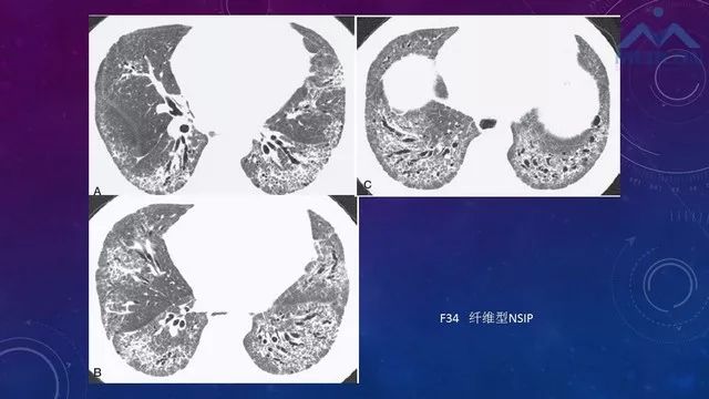 间质性肺疾病的影像识别