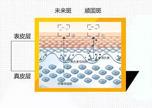 色素的原理_激光治疗色素病变原理(2)