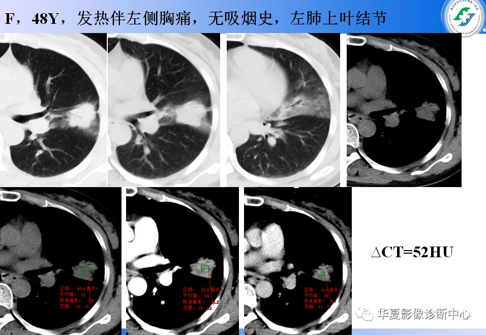 人口与肺炎_新冠肺炎图片