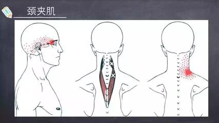 对颈神经的解剖及其末梢的中枢传入机制的研究 以及对颈椎间盘退行性