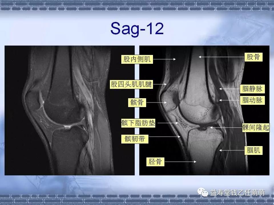 膝关节解剖讲解