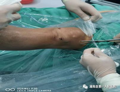 厉害了！我院骨科团队成功开展多例关节镜手术