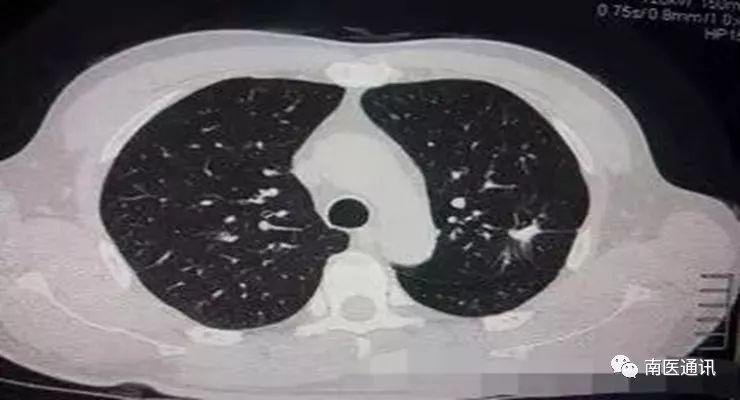 如何做低剂量肺部ct f811e38c1874499a89e35eec215d6d50.jpeg
