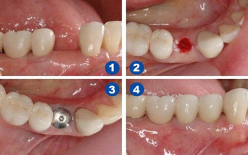 大连齿医生口腔科普哪种种植牙痛苦最小?专家解读种植牙难点问题