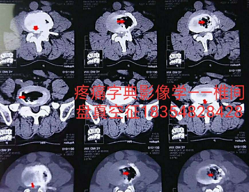 椎间盘真空征