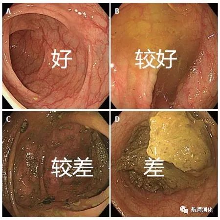 肠镜(五)洗肠前应知应会五件事