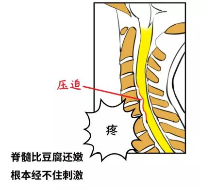恶心,呕吐,心慌,跟颈椎病也有关系?医生这样解释