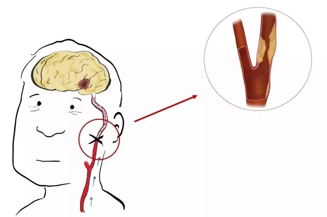 体检查出颈动脉斑块,你离脑中风还有多远?