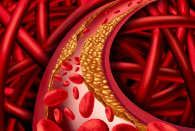 什么办法快速降脂 56f3ff451f0847a1a6dcd3e4b2aac81e.jpeg