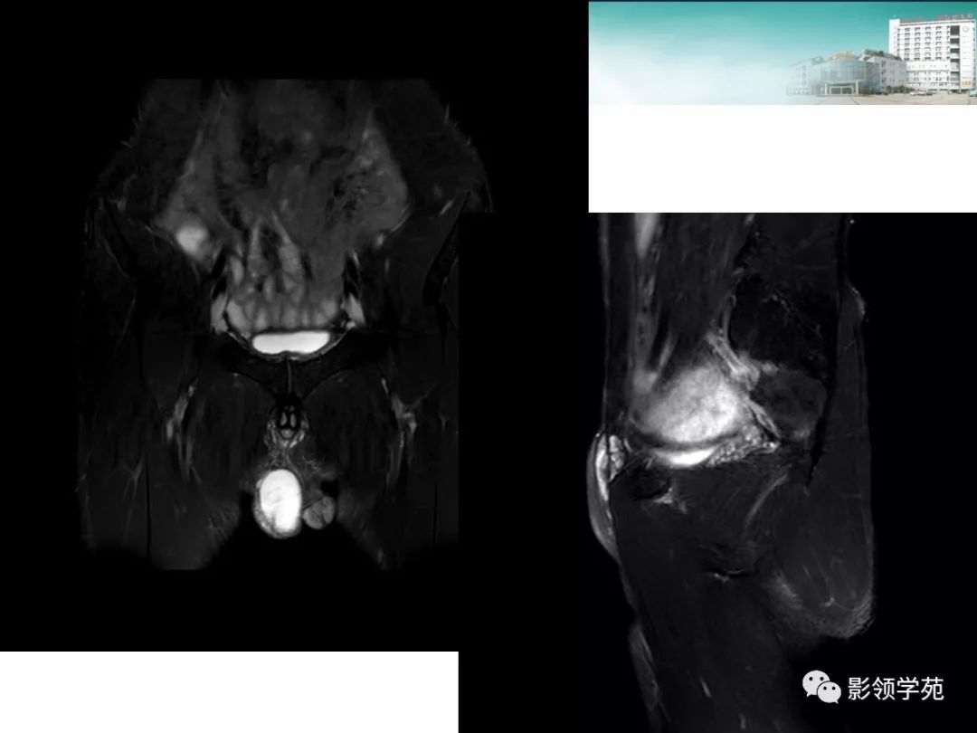 睾丸疾病mr诊断