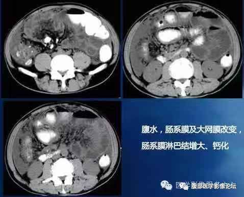 疾病谱肠系膜或网膜肿块实性