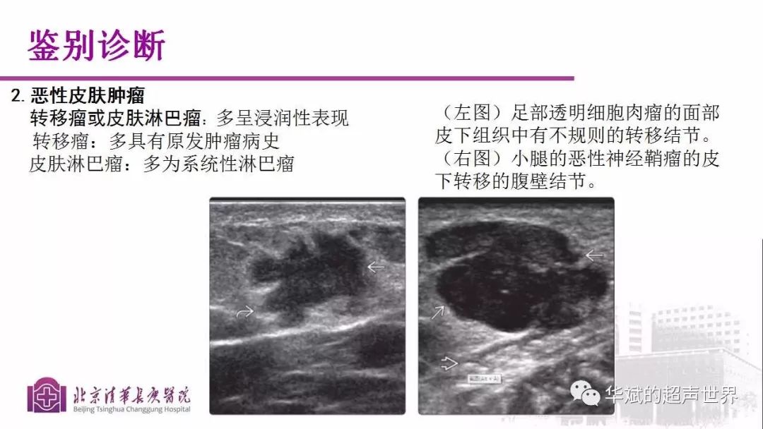 病例讨论及文献学习:隆突性皮肤纤维肉瘤