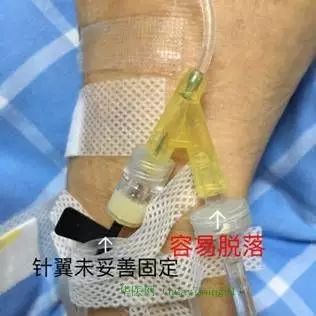 什么是留置针输液 b29cac9711ff4902a9cbe6f1d943e2b2.jpeg