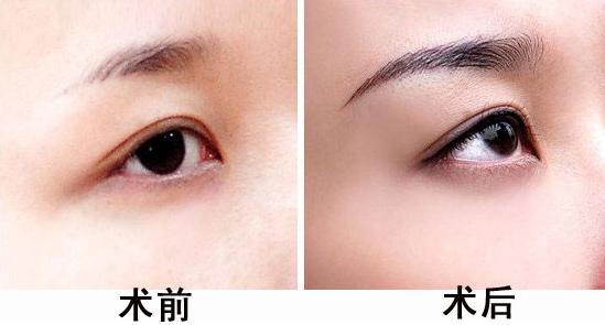 眉毛尾稀疏怎么办 b6bbdd8373a040319cab1d24b6fe0e2d.jpeg