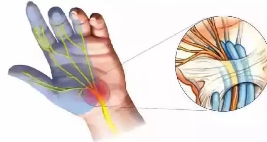 腕管综合征,由于手腕向内弯折导致腕管内正中神经受卡压引起