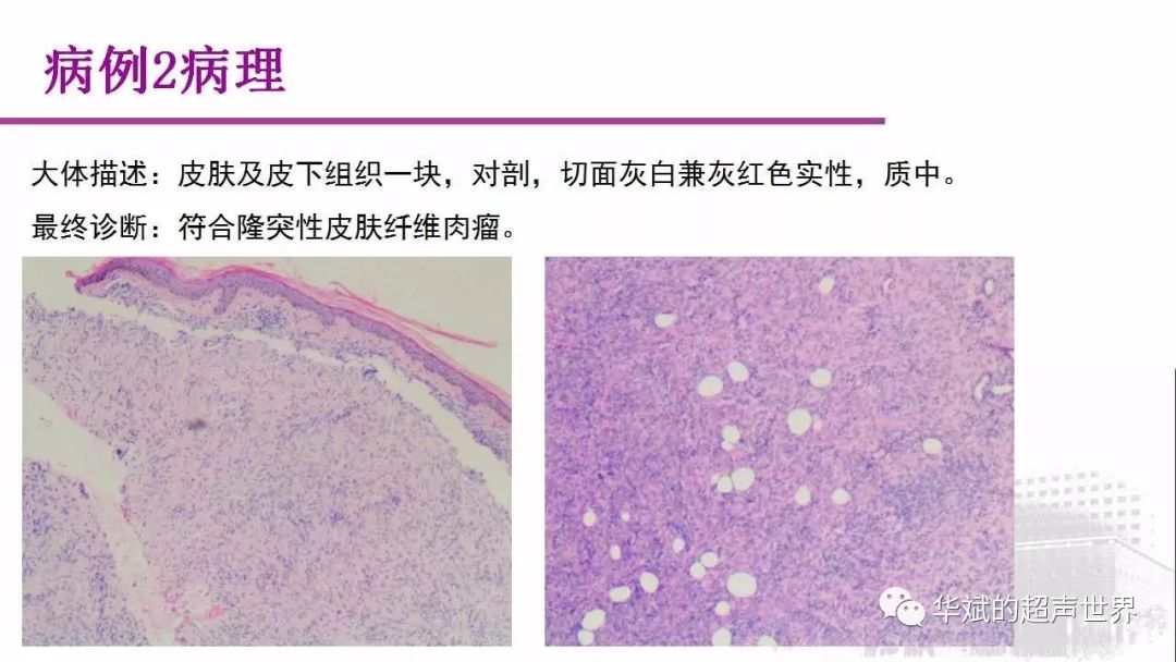 病例讨论及文献学习:隆突性皮肤纤维肉瘤