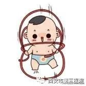 做一个温暖妈妈@【孕妈须知】脐带绕颈你了解么