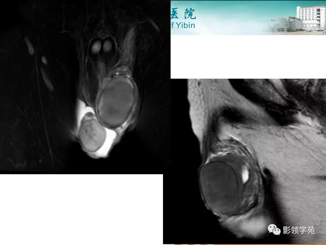 睾丸疾病mr诊断