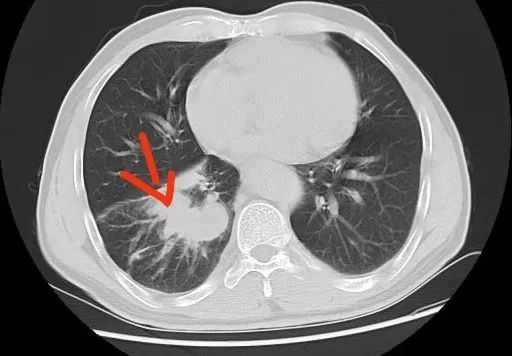体检胸片报告正常,ct却发现肺癌,到底什么情况?是胸片漏诊了吗?