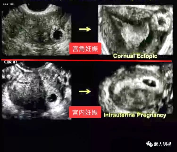 这个宫角妊娠危险吗