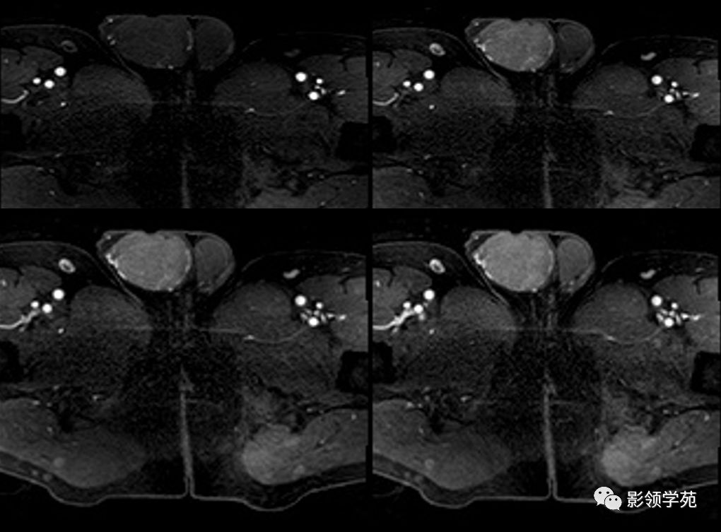 睾丸疾病mr诊断