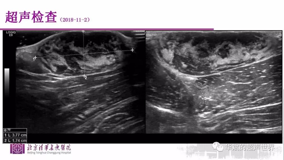 病例讨论及文献学习:隆突性皮肤纤维肉瘤