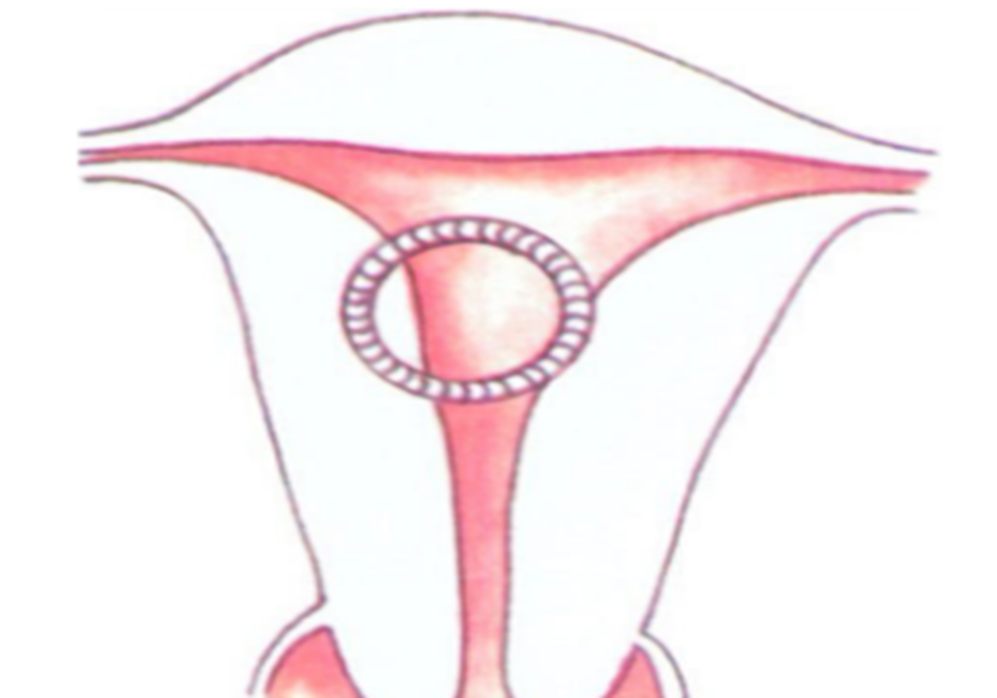 啥时候上环最合适 1ae26f05ef334709b1964a96919e9ca4.jpeg