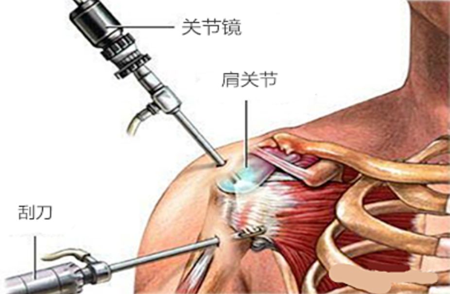 肩关节镜手术适应症