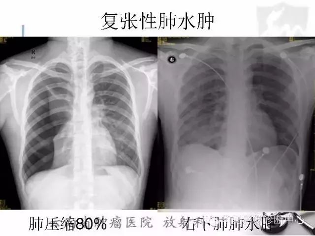 在实际案例中如何用x线来区分肺水肿和肺淤血