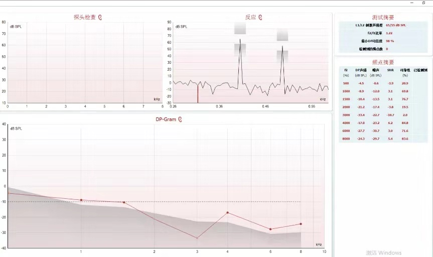 声导抗:双耳声导抗a型.