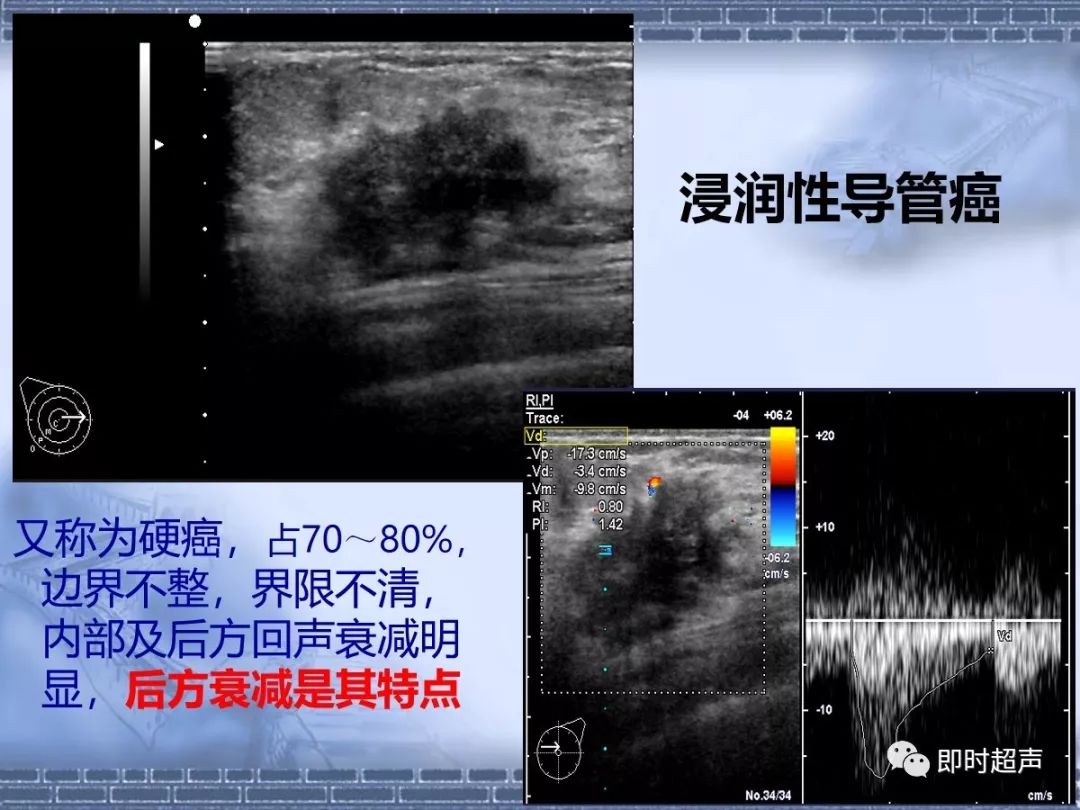 乳腺癌的超声诊断