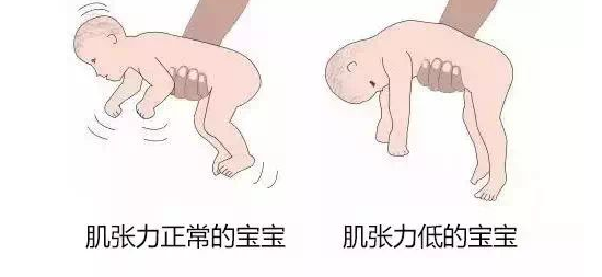 4个月男宝宝肌张力较高，肌张力是什么意思？