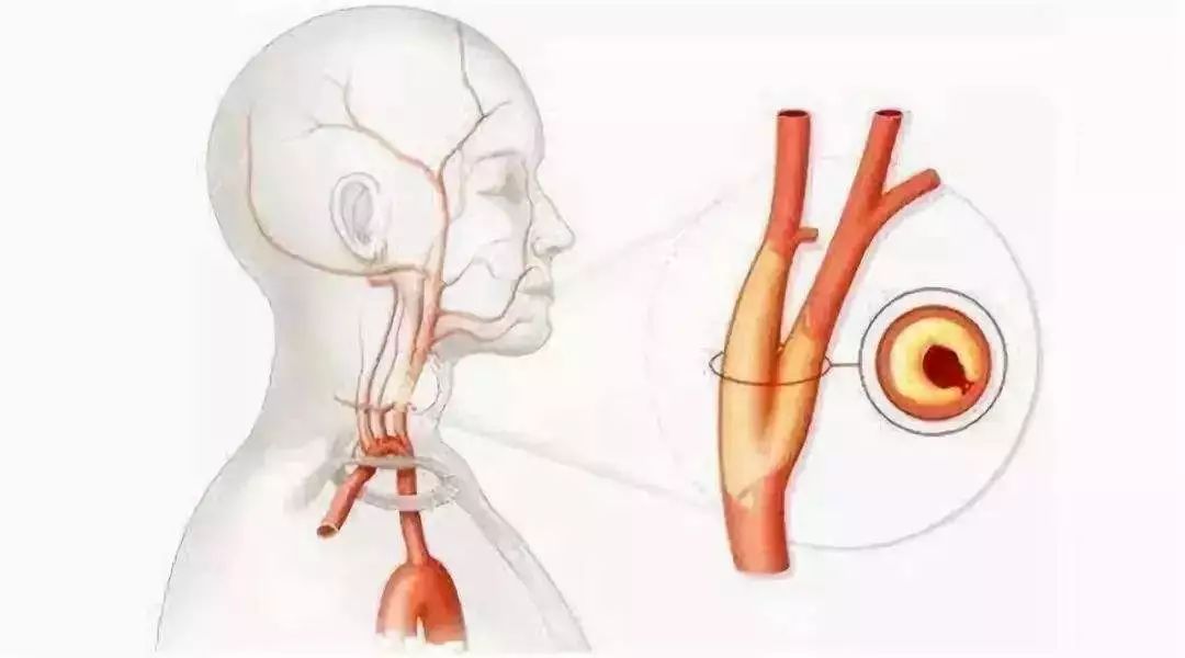这根血管就在我们的脖子两侧——颈动脉,用手轻轻一摸就能摸到它在
