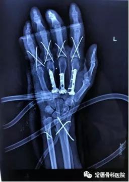 常德骨科医院乾坤大挪移,以大腿之肉补救