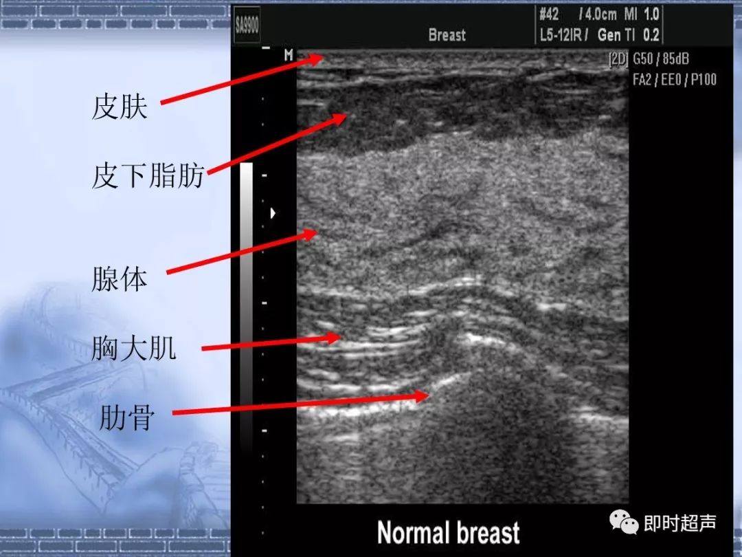 正常乳腺结构(性成熟期乳腺)乳头呈低回声近似椭圆形哺乳期乳腺皮下