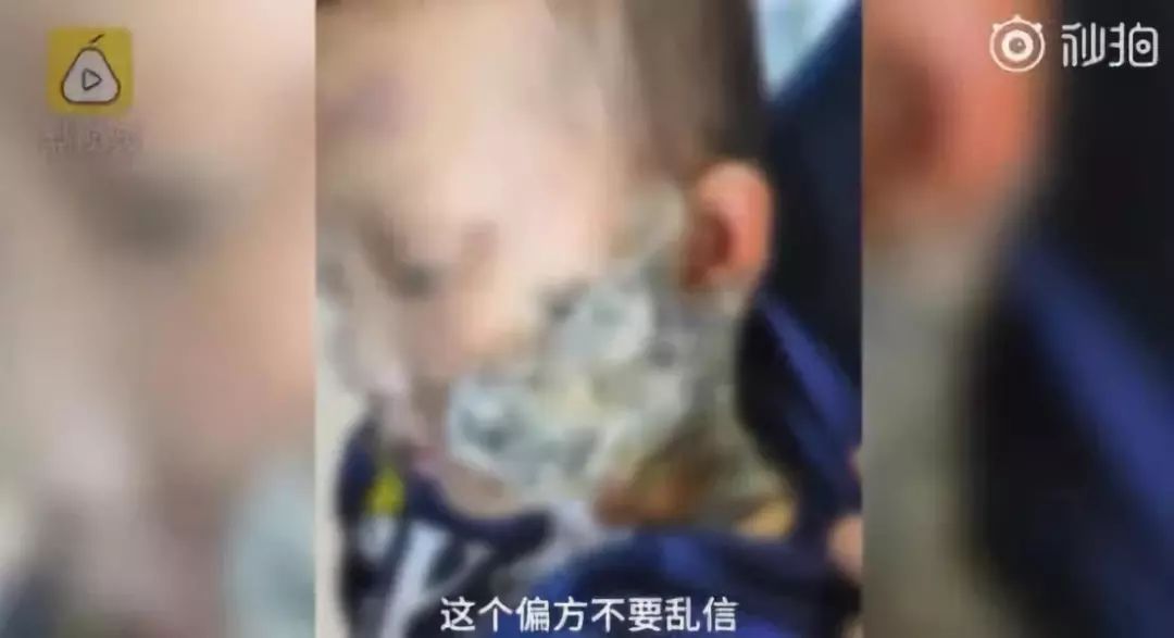 [宝宝呵护]宝宝烫伤后，家长一个举动让宝宝感染住院，这些方法不是爱宝宝而是害宝宝