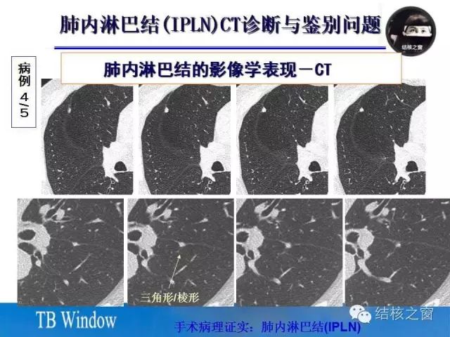 肺内淋巴结的ct表现与鉴别诊断