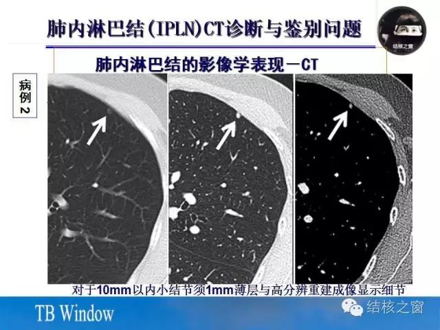 肺内淋巴结的ct表现与鉴别诊断_结核