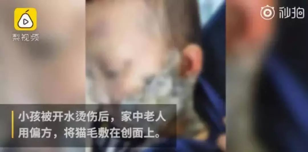 [宝宝呵护]宝宝烫伤后，家长一个举动让宝宝感染住院，这些方法不是爱宝宝而是害宝宝