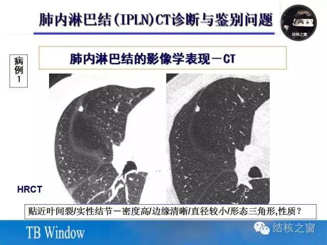 肺内淋巴结的ct表现与鉴别诊断_结核