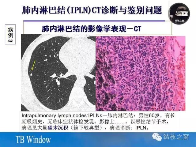 肺内淋巴结的ct表现与鉴别诊断_结核