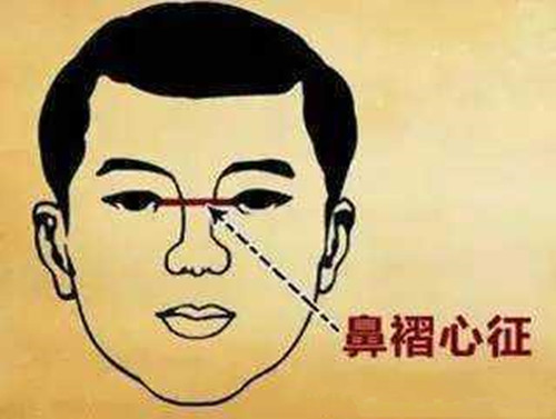 第二处就是鼻梁，就是两眼之间、鼻梁之上出现一道横纹，且比较深。一般