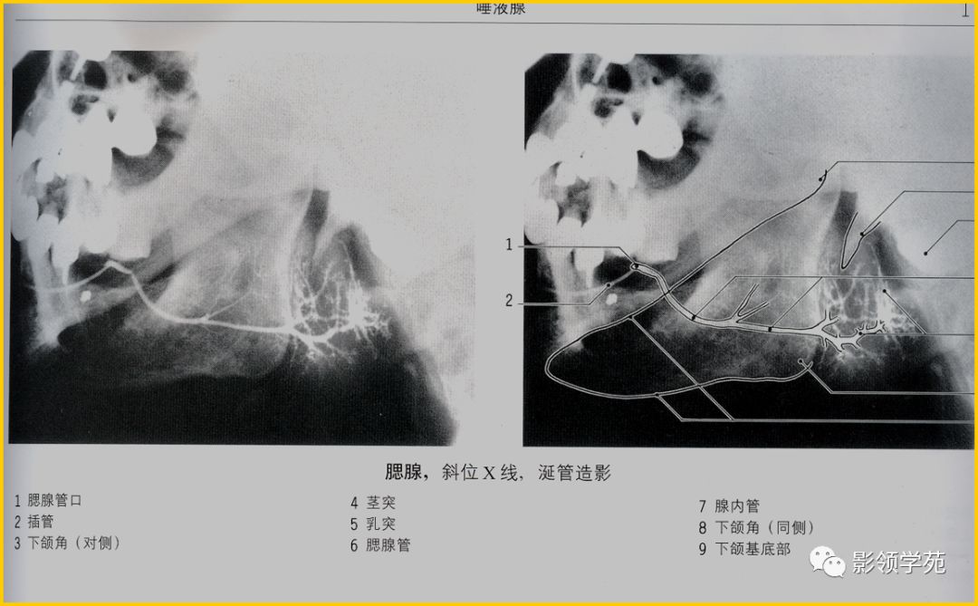 腮腺颈部疾病影像诊断