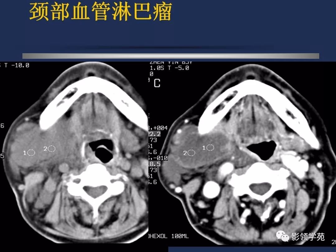 腮腺颈部疾病影像诊断