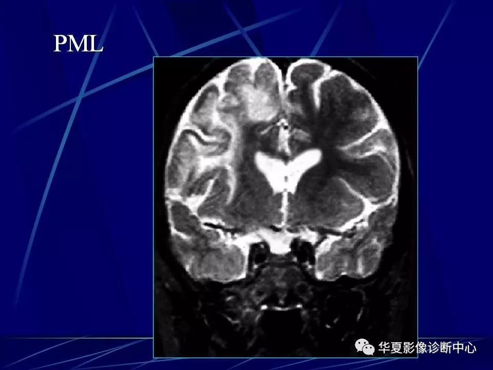 病毒,霉菌及寄生虫引起,影像学检查特别是ct和mri在临床诊断中起着较