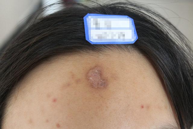 自己怎样修复凹陷 794e36fc61594b7bb9d72d74f0faaf14.jpeg