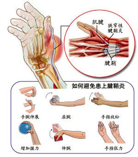 手指疼痛还会"啪啪"作响的人要注意!你可能被腱鞘炎盯上了