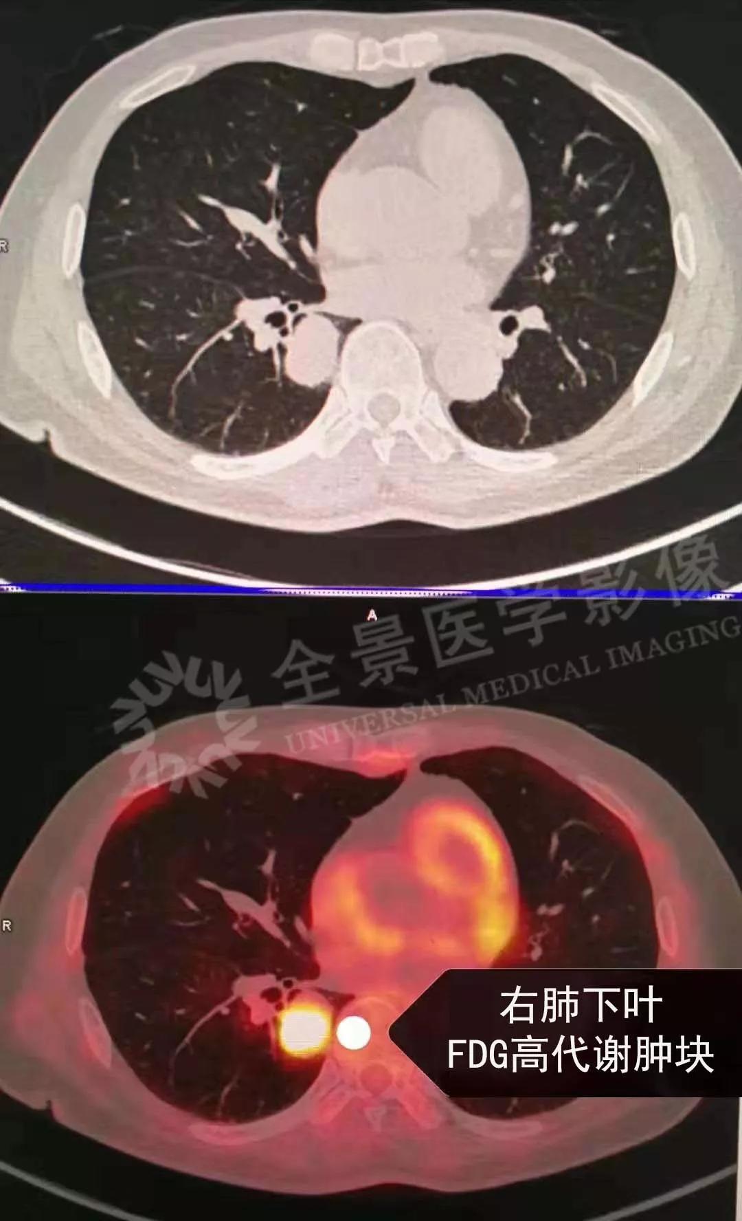 提示为恶性肿瘤,且右肺门发现增大淋巴结