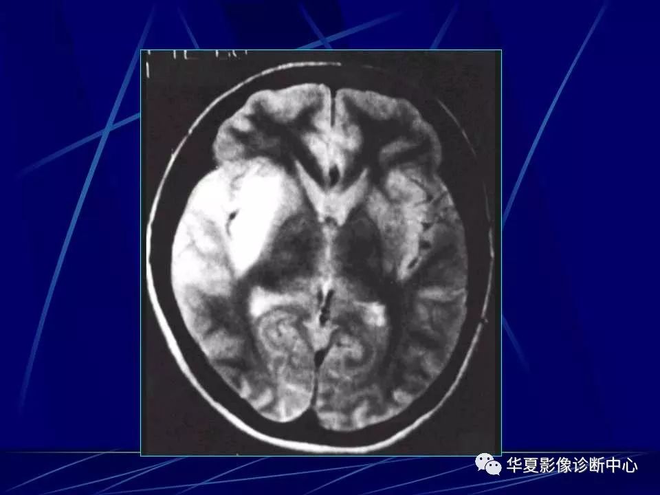 病毒,霉菌及寄生虫引起,影像学检查特别是ct和mri在临床诊断中起着较
