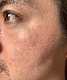 皮肤修复屏障要多久 fbc56d75c9614936966729e052bcc9c1.jpeg